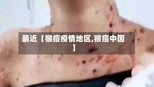 最近【猴痘疫情地区,猴痘中国】