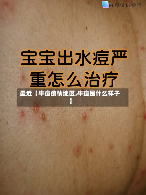 最近【牛痘疫情地区,牛痘是什么样子】
