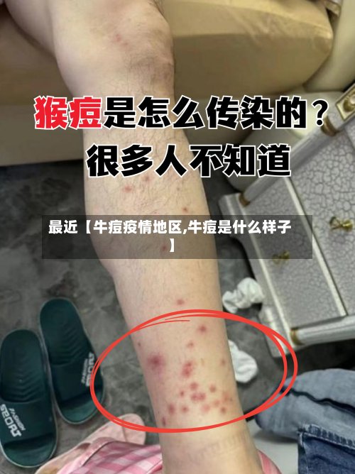 最近【牛痘疫情地区,牛痘是什么样子】-第3张图片