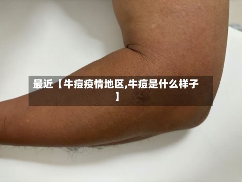 最近【牛痘疫情地区,牛痘是什么样子】-第2张图片